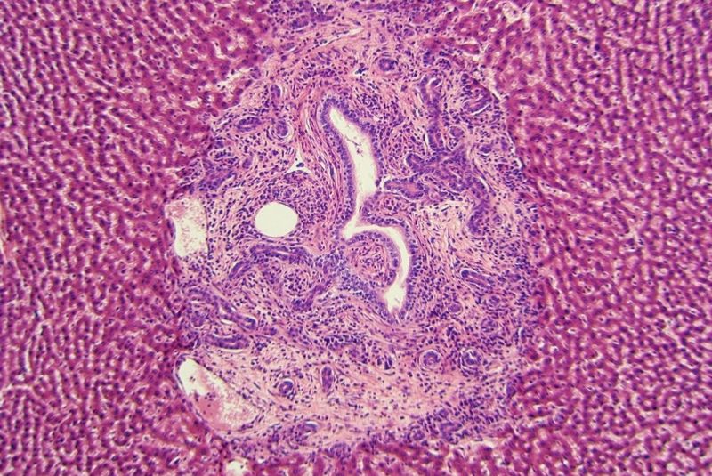 Microscopic image of healthy human tissue with a cancerous tumour growing in the middle. The uncontrolled, messy shape of the tumour is clearly visible from the otherwise regular tissue.